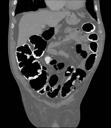 CT Colonography CT Colonography